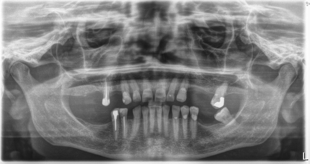 implant zęba Szczygieł stomatologia