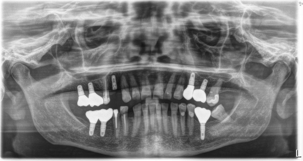 implant zęba stomatologia szczygieł