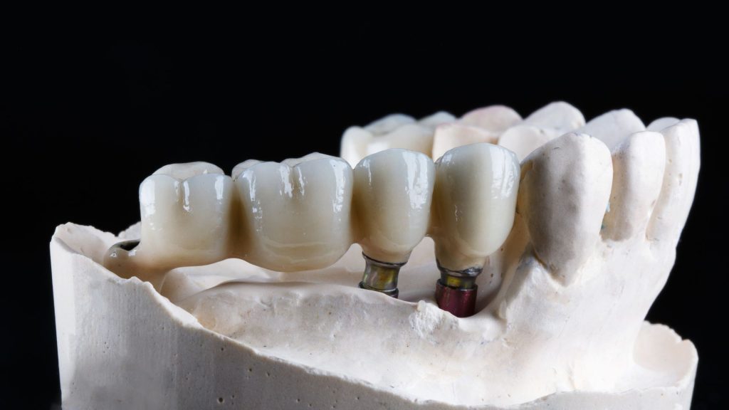Trwałe rozwiązania stomatologiczne, protetyka na implantach