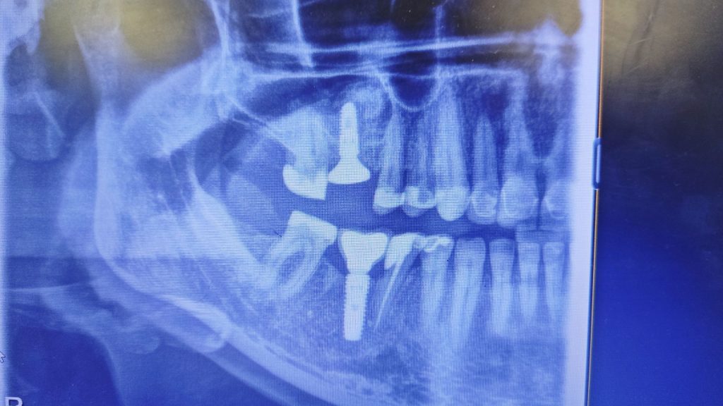implant zęba cena