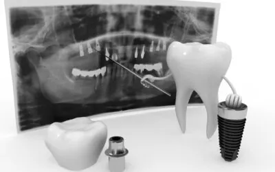 Implanty zębów Białystok – wizyta konsultacyjna