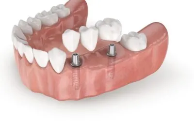 Procedura Implantacji Zębów Krok po&nbsp;Kroku: Co&nbsp;Pacjenci Powinni Wiedzieć