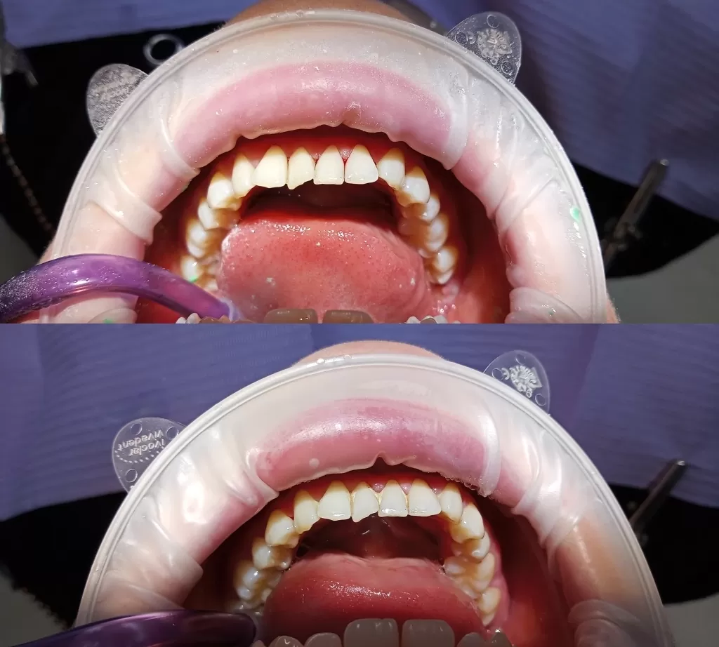 usuwanie kamienia białystok