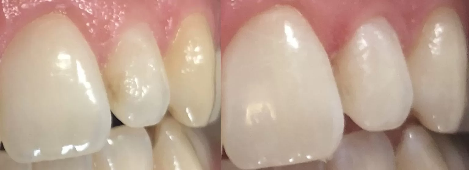 icon leczenie próchnicy białystok