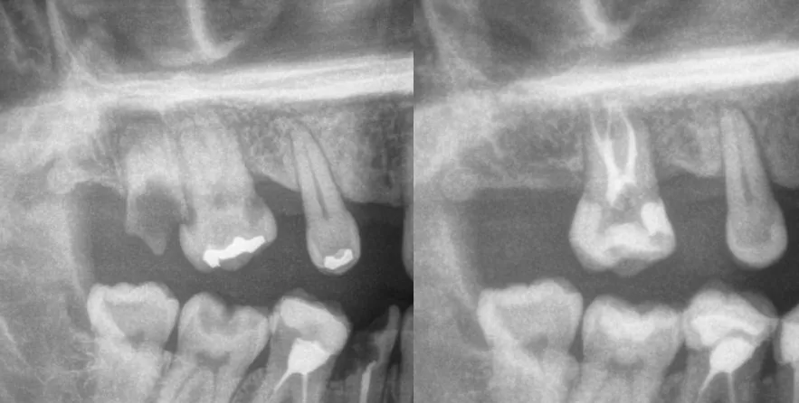 leczenie endodontyczne białystok
