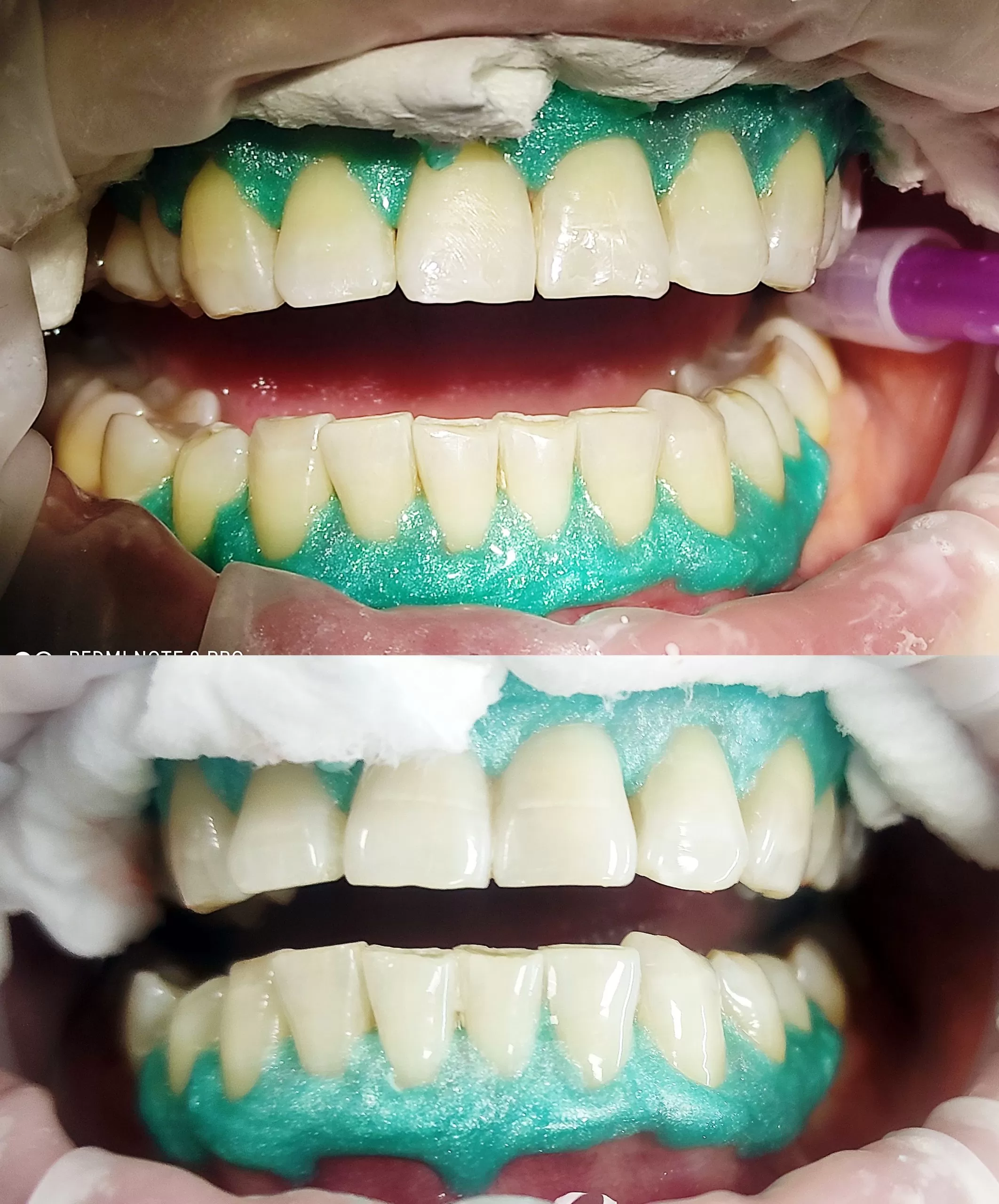 wybielanie zębów lampą w&nbsp;doskonałej cenie białystok